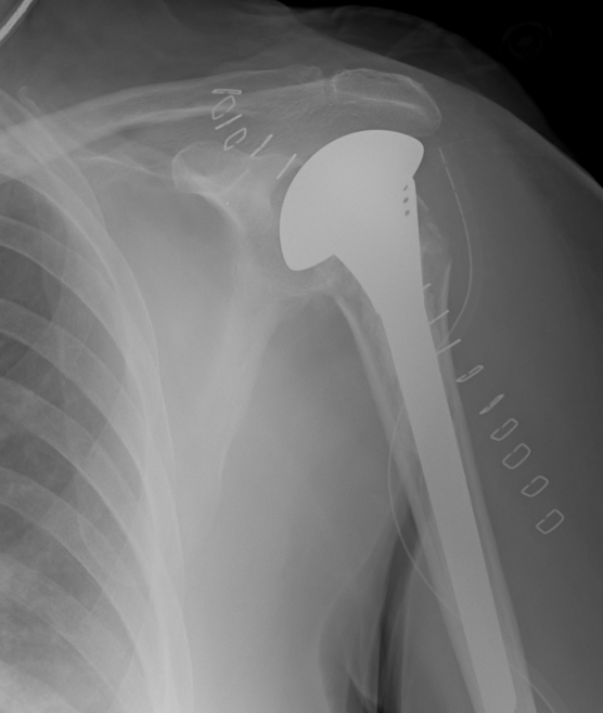 Shoulder Hemiarthroplasty Trauma 2